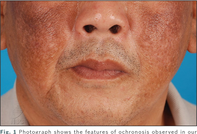 Alkaptonuria