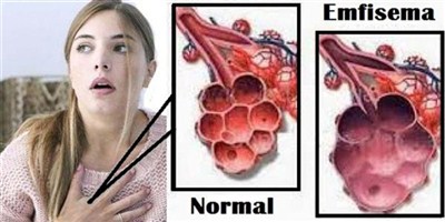Emfisema