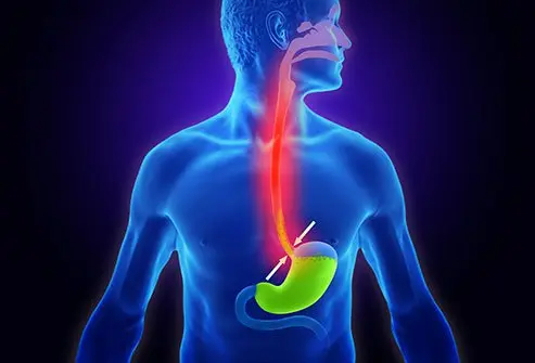 GERD (Gastroesophageal Reflux Disease)