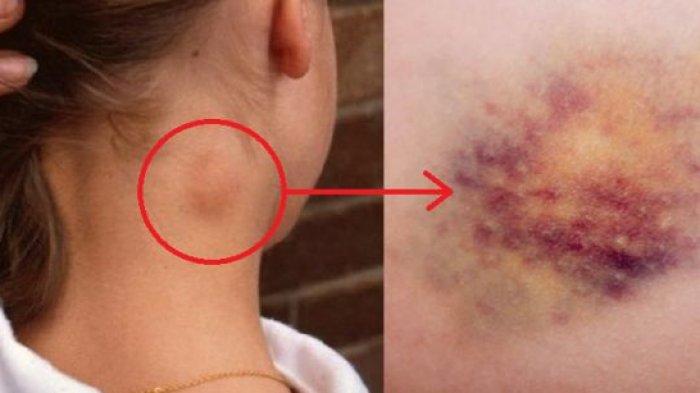 Leukemia