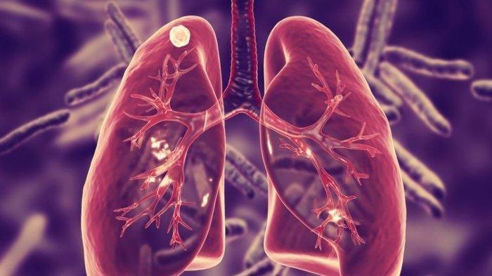 Bronkiolitis