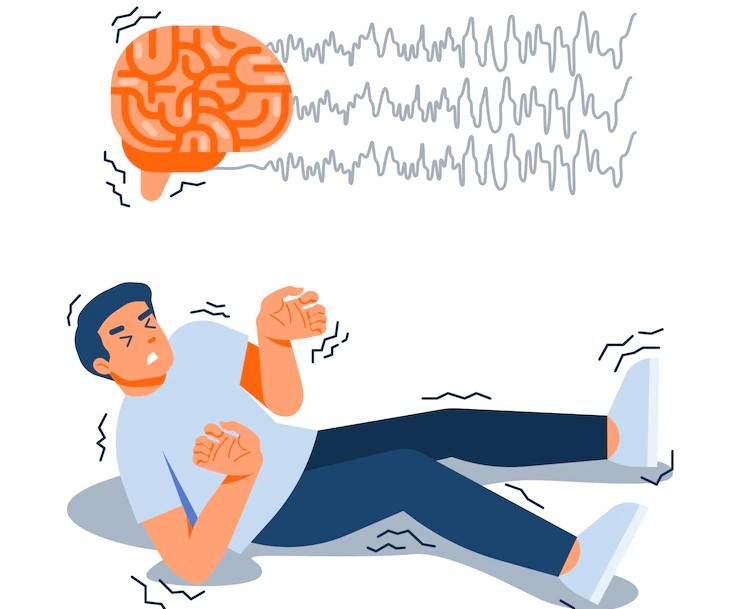 Epilepsi