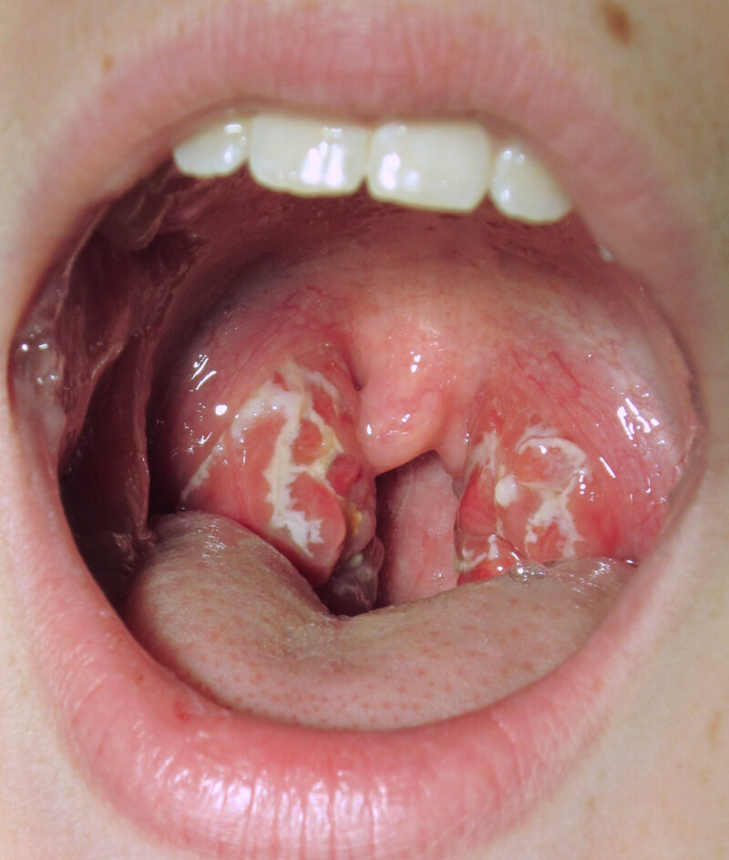 Faringitis