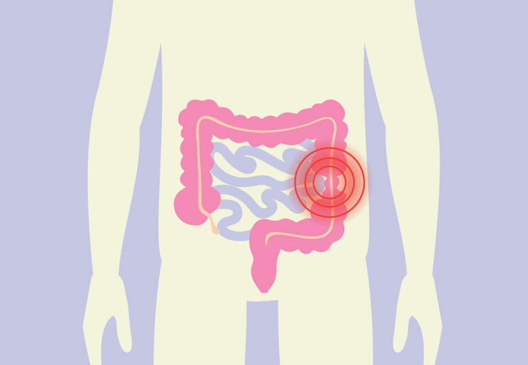 Irritable Bowel Syndrome (IBS)