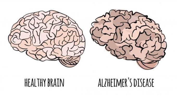 Efek Neuroprotektor Kunyit pada Pasien Alzheimer