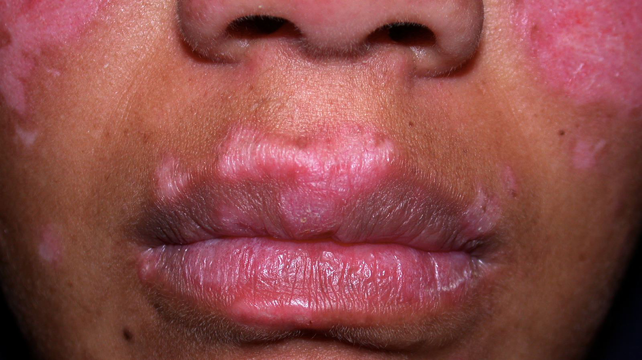 Lupus