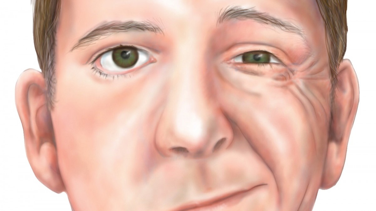 Bell’s Palsy