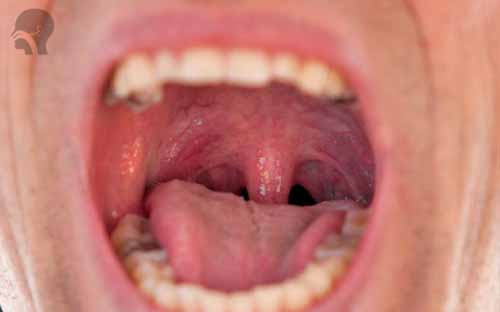 Epiglotitis