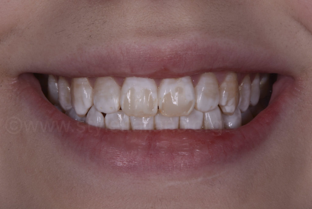 Fluorosis