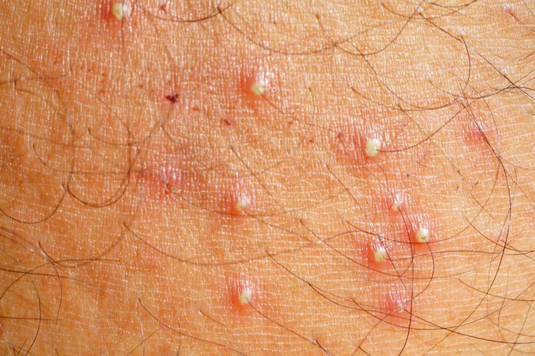 Folikulitis