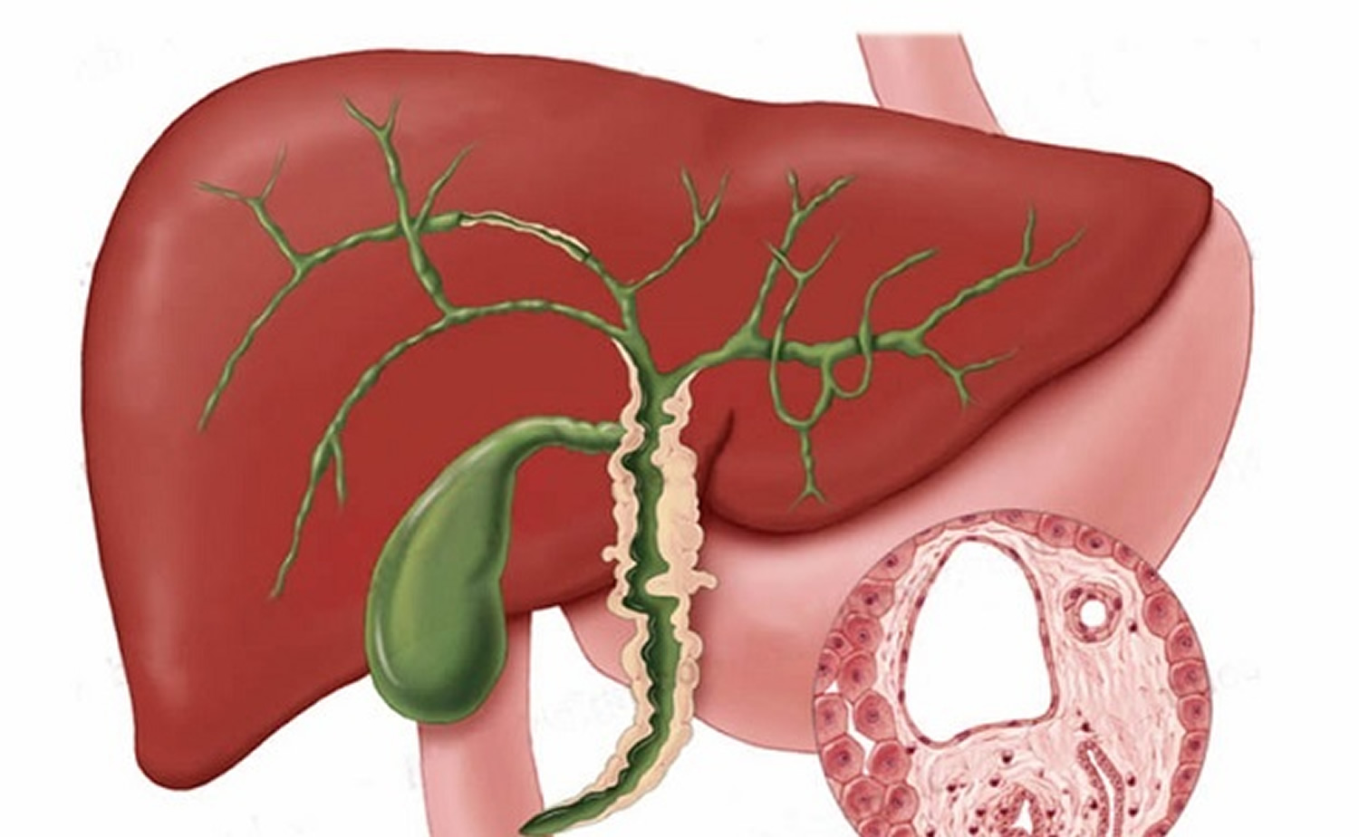 Cholangitis