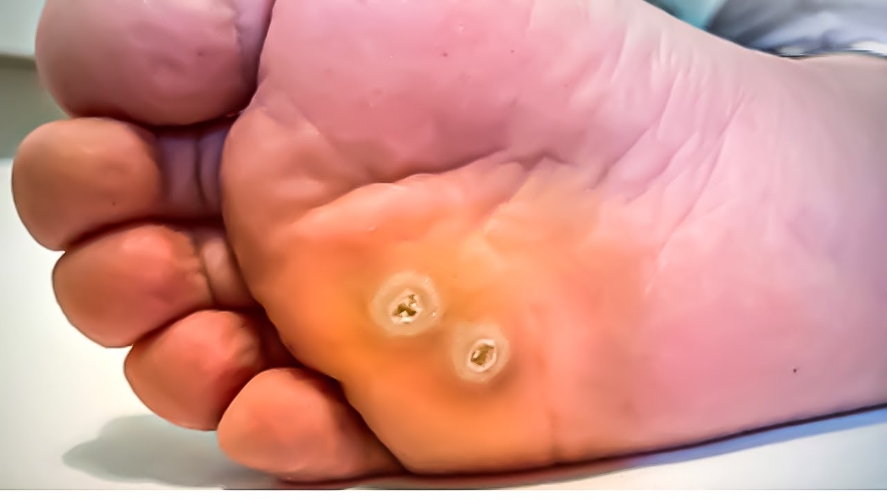 Heloma