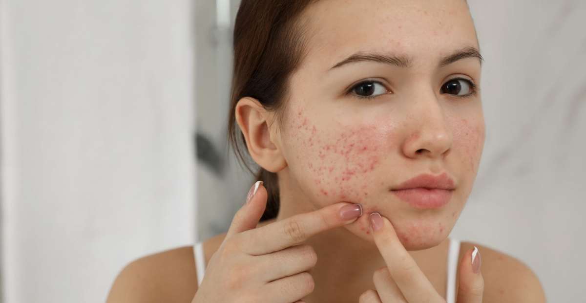 Jerawat (Acne)