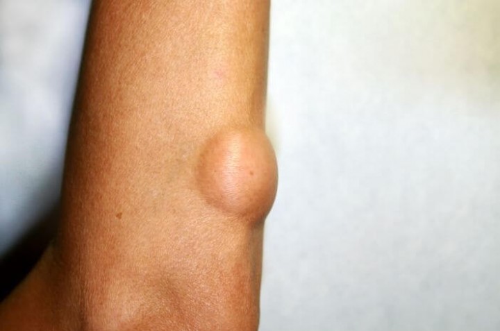 Lipoma