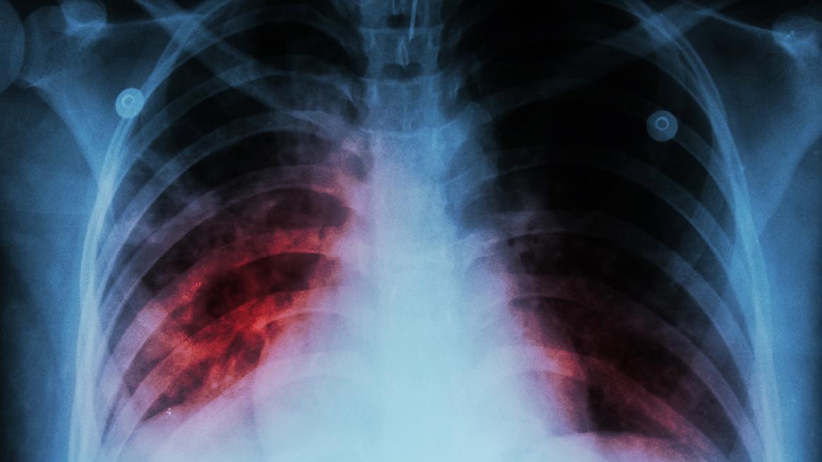 Tuberkolosis