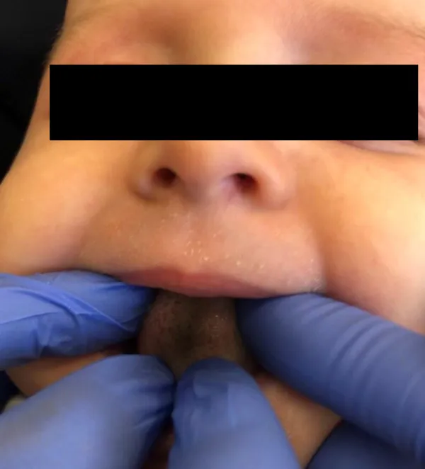 Black Hairy Tounge,  Lingua Villosa Nigra (Lidah Berbulu Hitam)