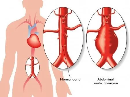 Aneurisma Aorta Perut (Pelebaran Aorta Perut)