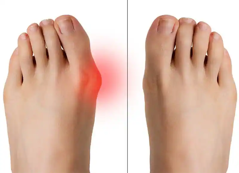 Hallux Valgus (Bunion)