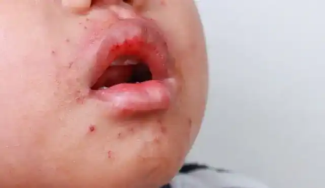 Campak Jerman (Rubella)