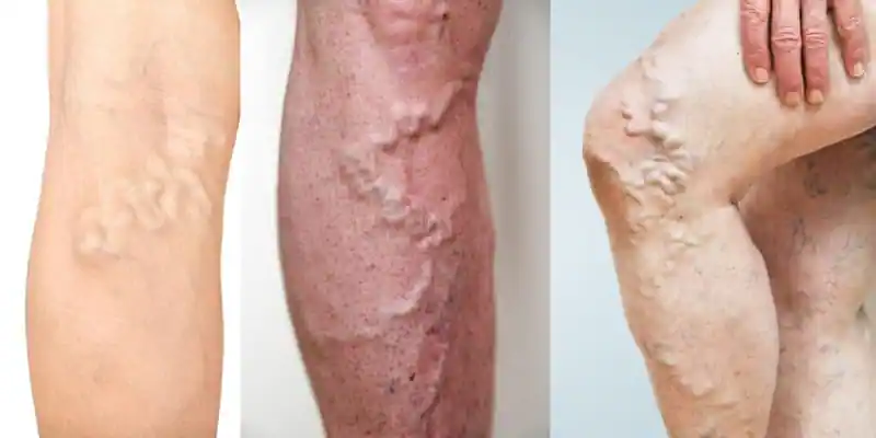 Deep Vein Thrombosis (DVT)