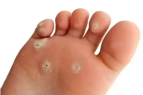 Kapalan (Callus)