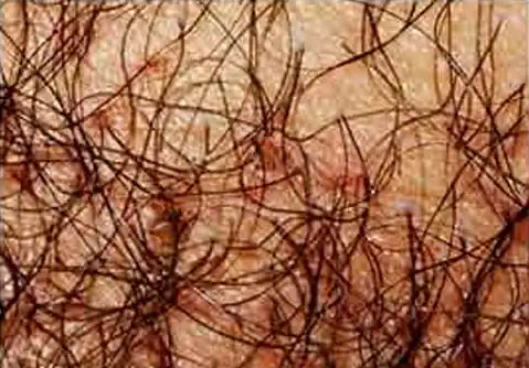 Kutu Kelamin (Pediculosis Pubis)