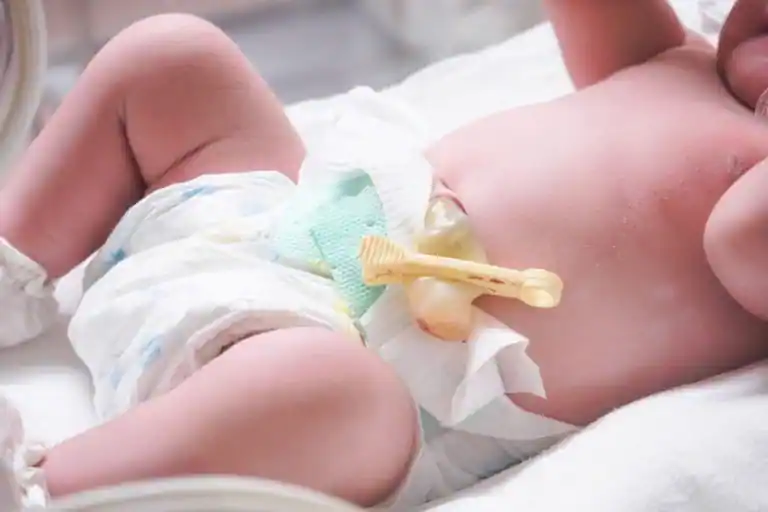 Infeksi Pusar Bayi (Omphalitis)