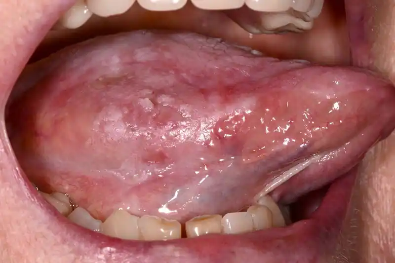 Oral Cancer (Kanker mulut)