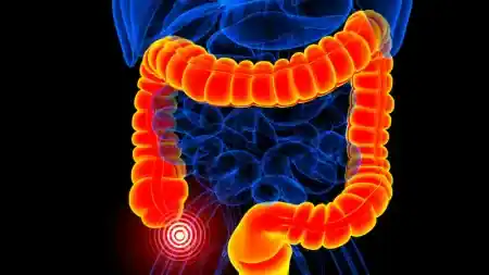 Radang Usus Buntu (Apendisitis)