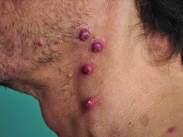 Bacillary Angiomatosis