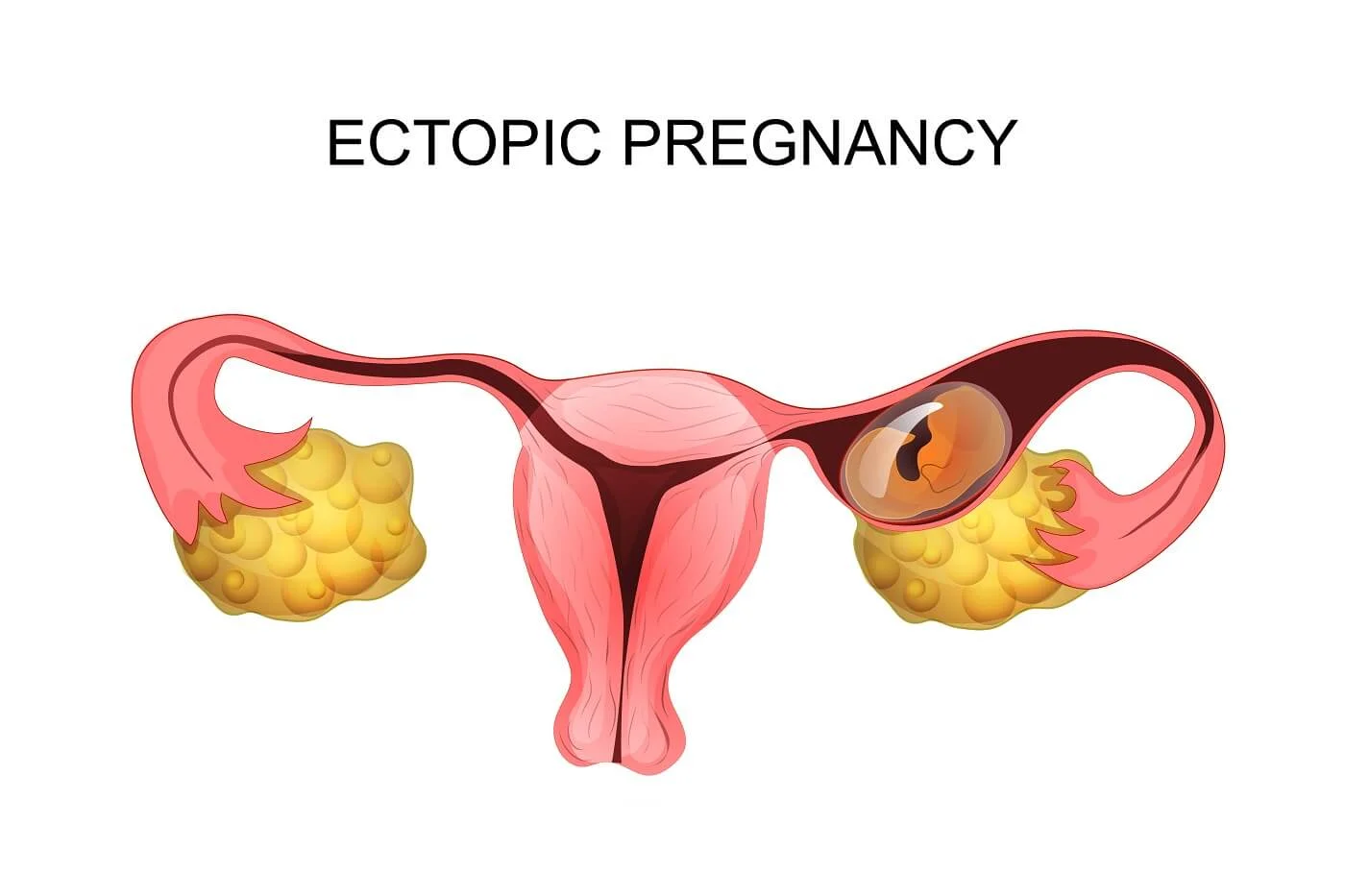 Ectopic Pregnancy (Kehamilan Ektopik)