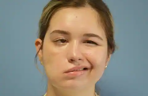 Facial Nerve Palsy (Kelumpuhan Saraf Wajah)