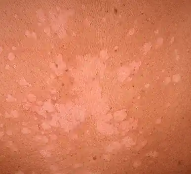 Panu (Tinea Versicolor)